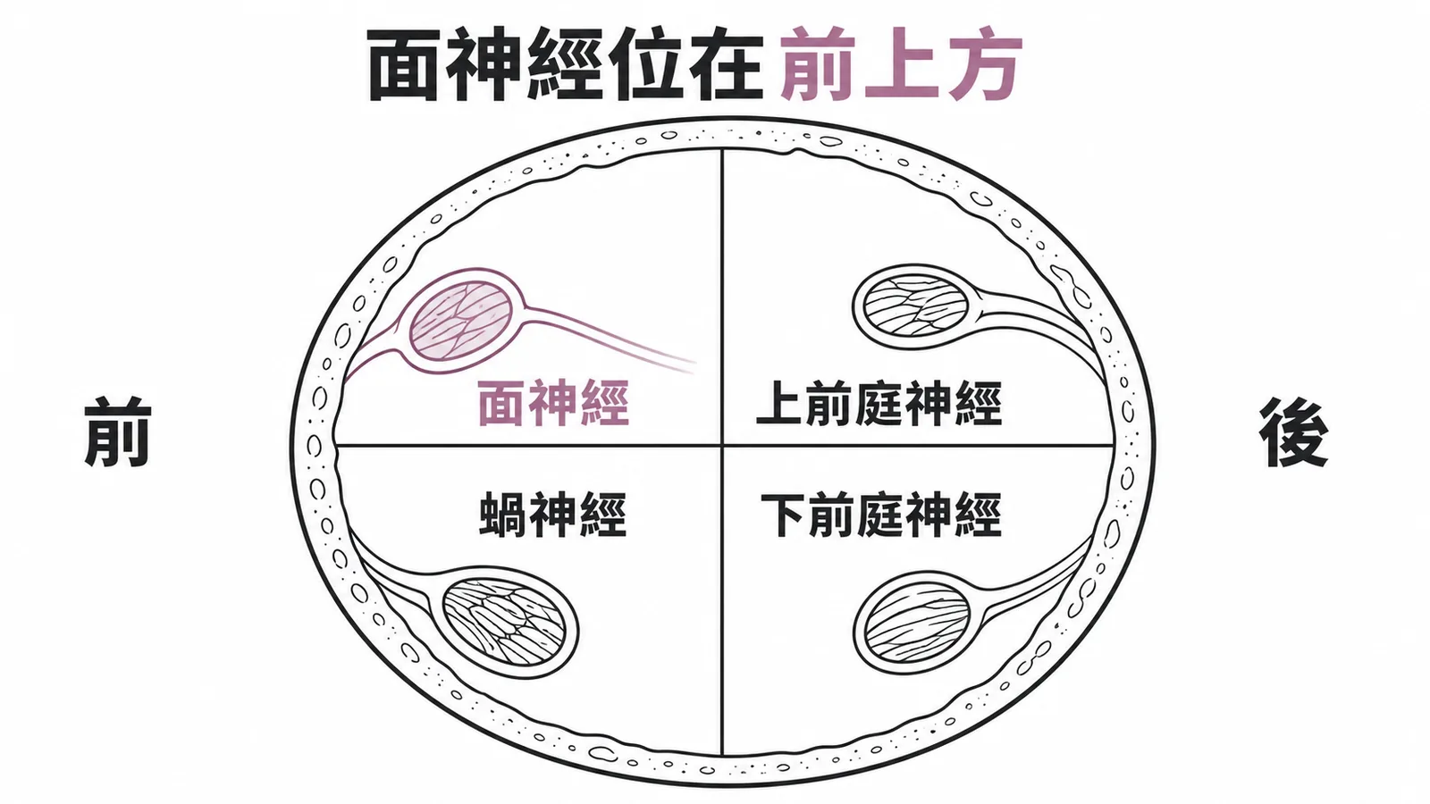 內聽道橫切面：面神經位在前上方，蝸神經前下，前庭神經後方
