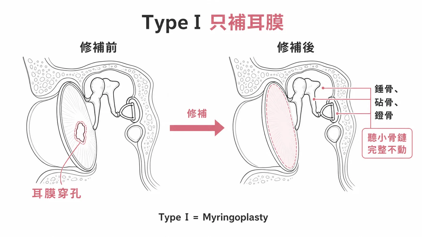 第一型鼓室成型術只修補耳膜，聽小骨鏈完整不動