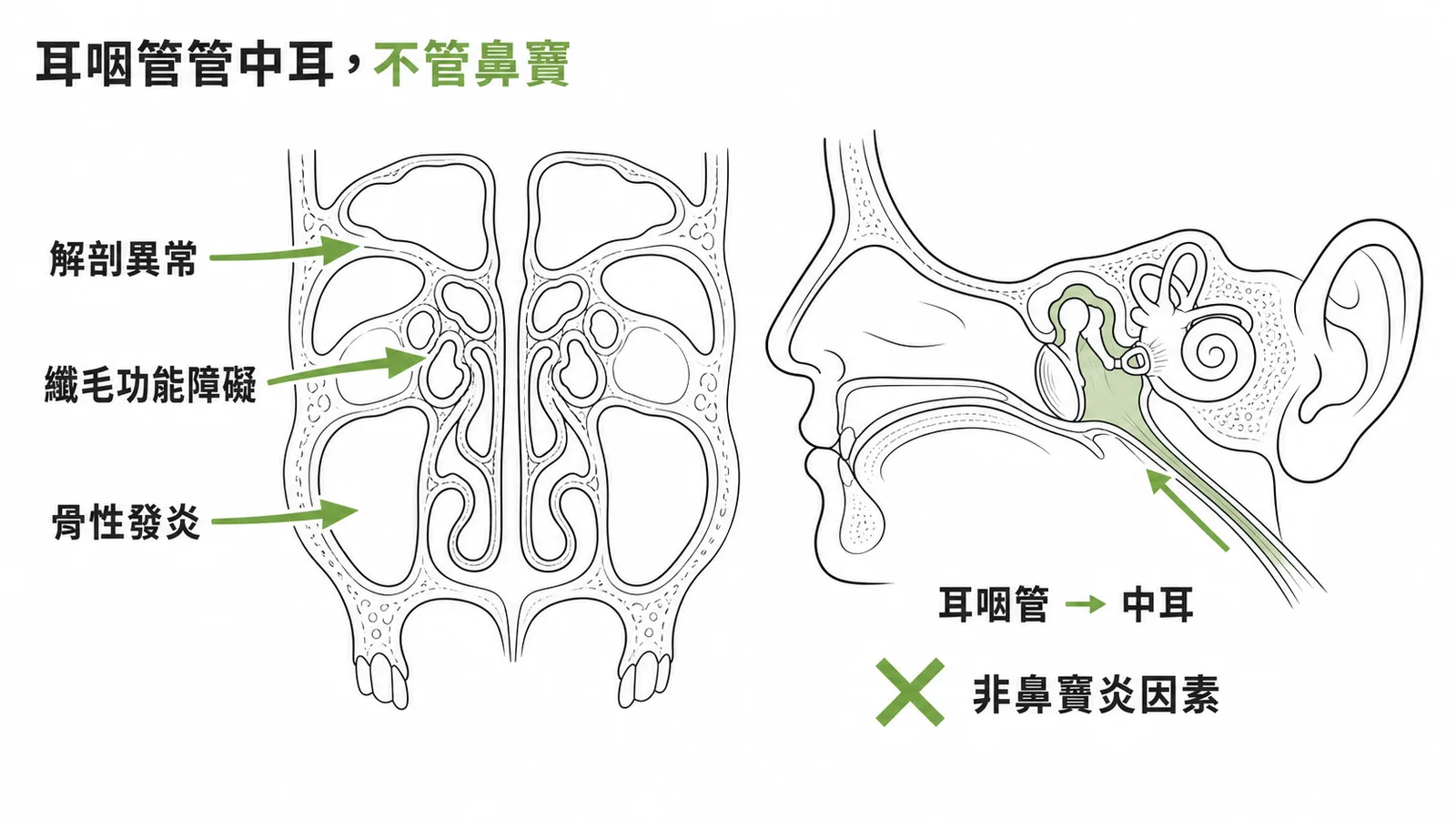 耳咽管管中耳非鼻竇，慢性鼻竇炎致病為解剖異常、纖毛障礙、骨性發炎