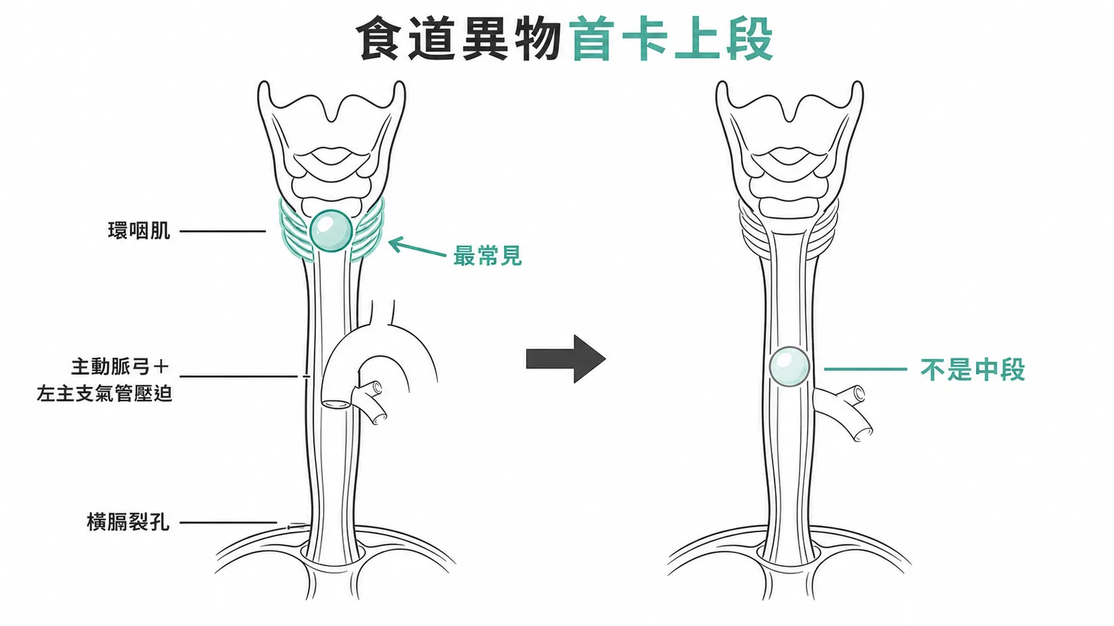 食道三個生理性狹窄處，異物最常卡在上段環咽肌處