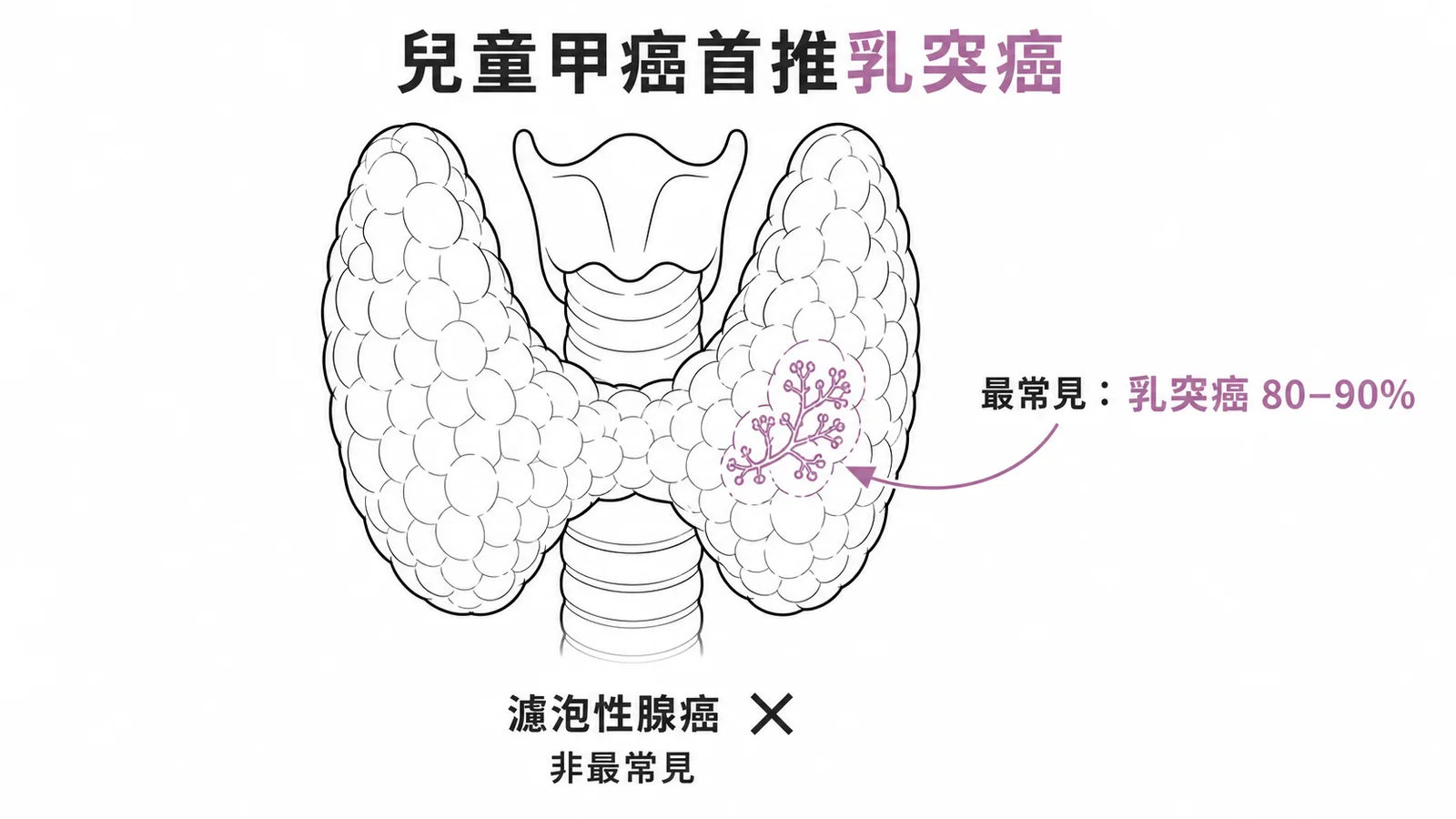 兒童甲狀腺癌最常見為乳突癌佔80-90%，非濾泡性腺癌