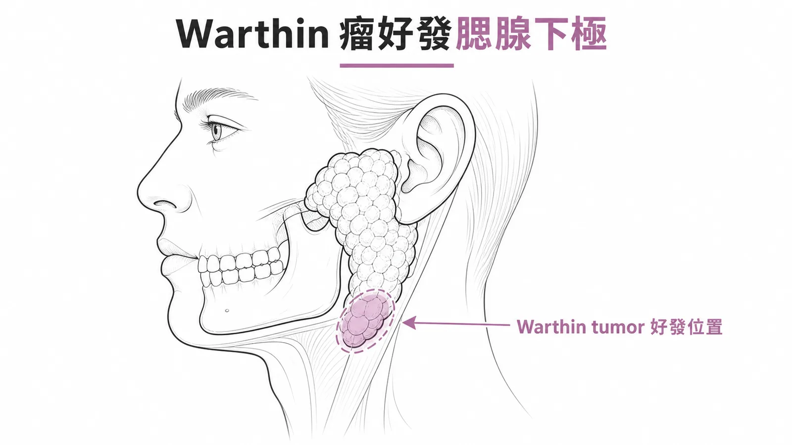 Warthin瘤好發於腮腺下極位置示意圖