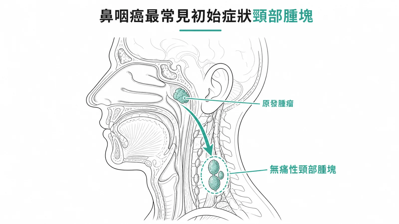 鼻咽癌最常見初始症狀為無痛性頸部淋巴結腫塊