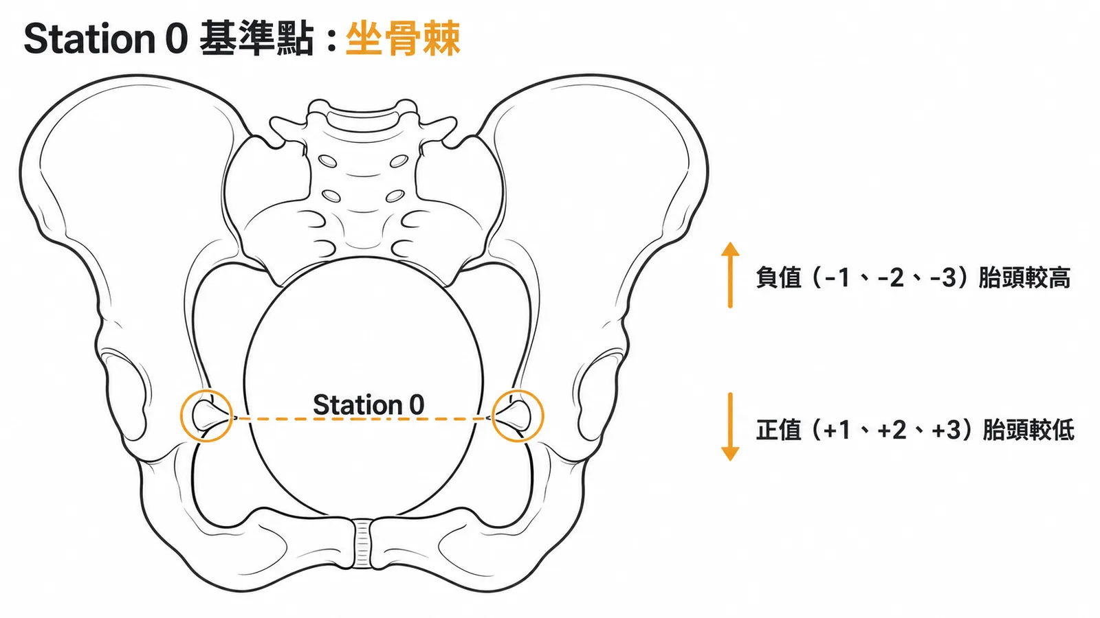 Fetal station基準點為坐骨棘,Station 0在坐骨棘平面