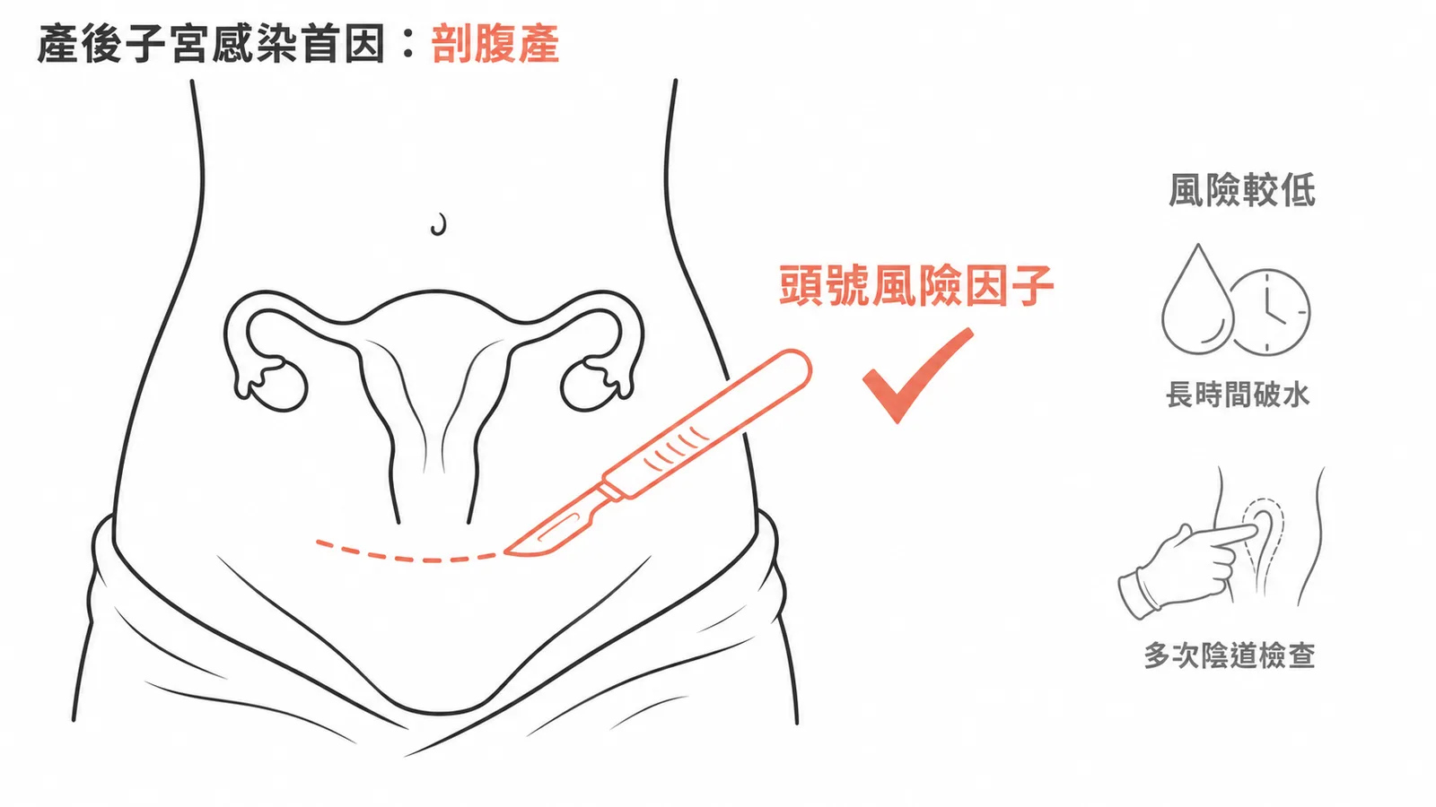 產後子宮感染的頭號風險因子為剖腹產