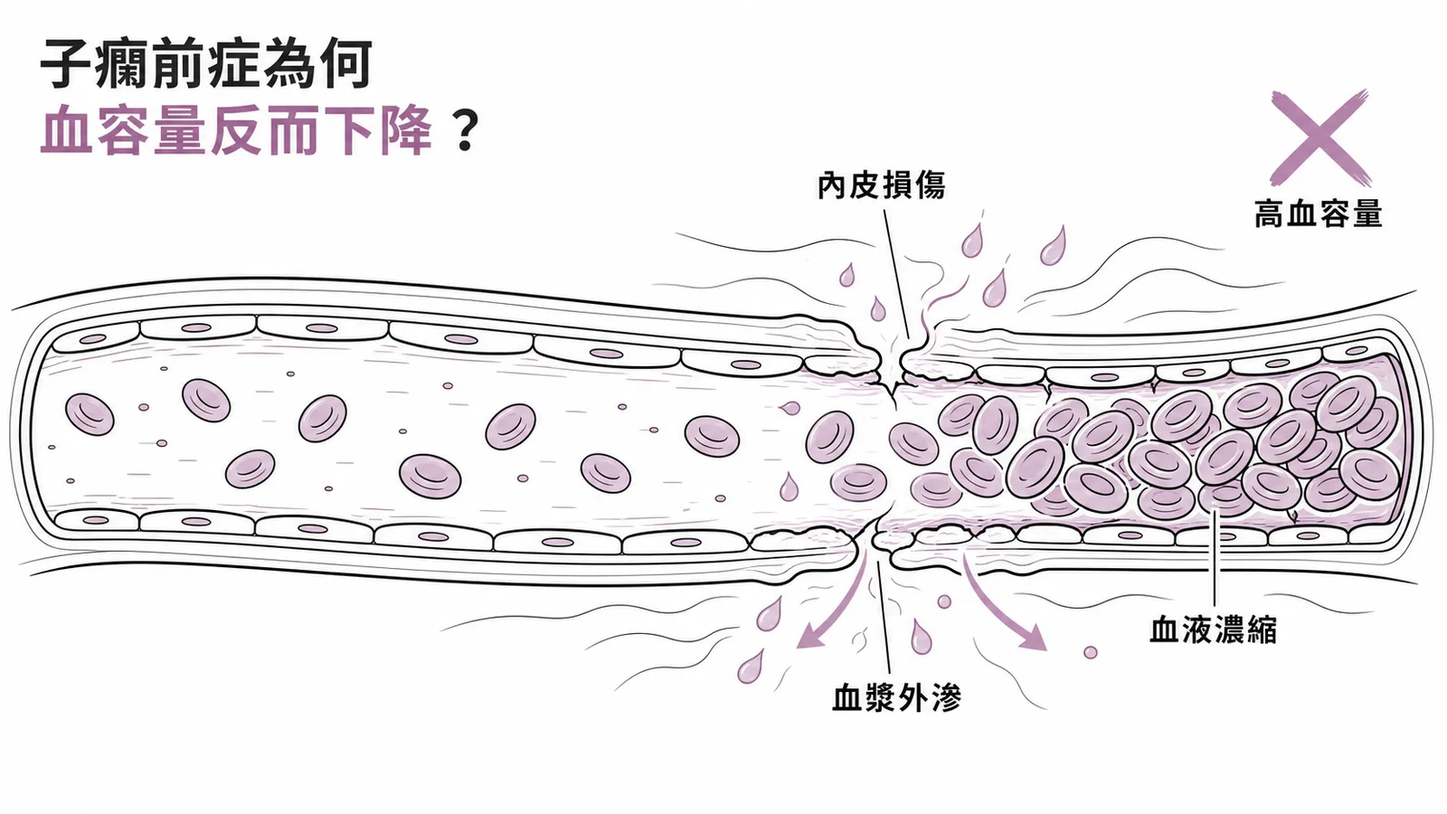 子癇前症血管內皮損傷導致血漿外滲與血液濃縮,高血容量並非其特點