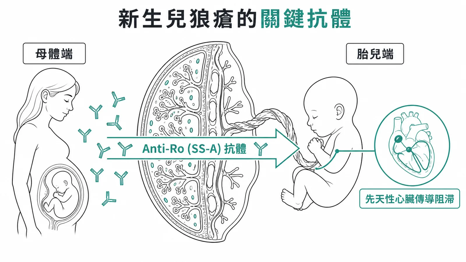 Anti-Ro抗體經胎盤傳至胎兒導致先天性心臟傳導阻滯
