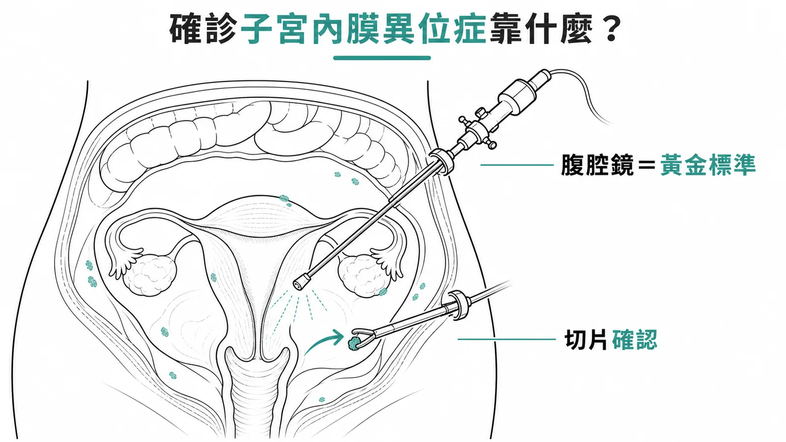 子宮內膜異位症確診黃金標準為腹腔鏡直視加切片