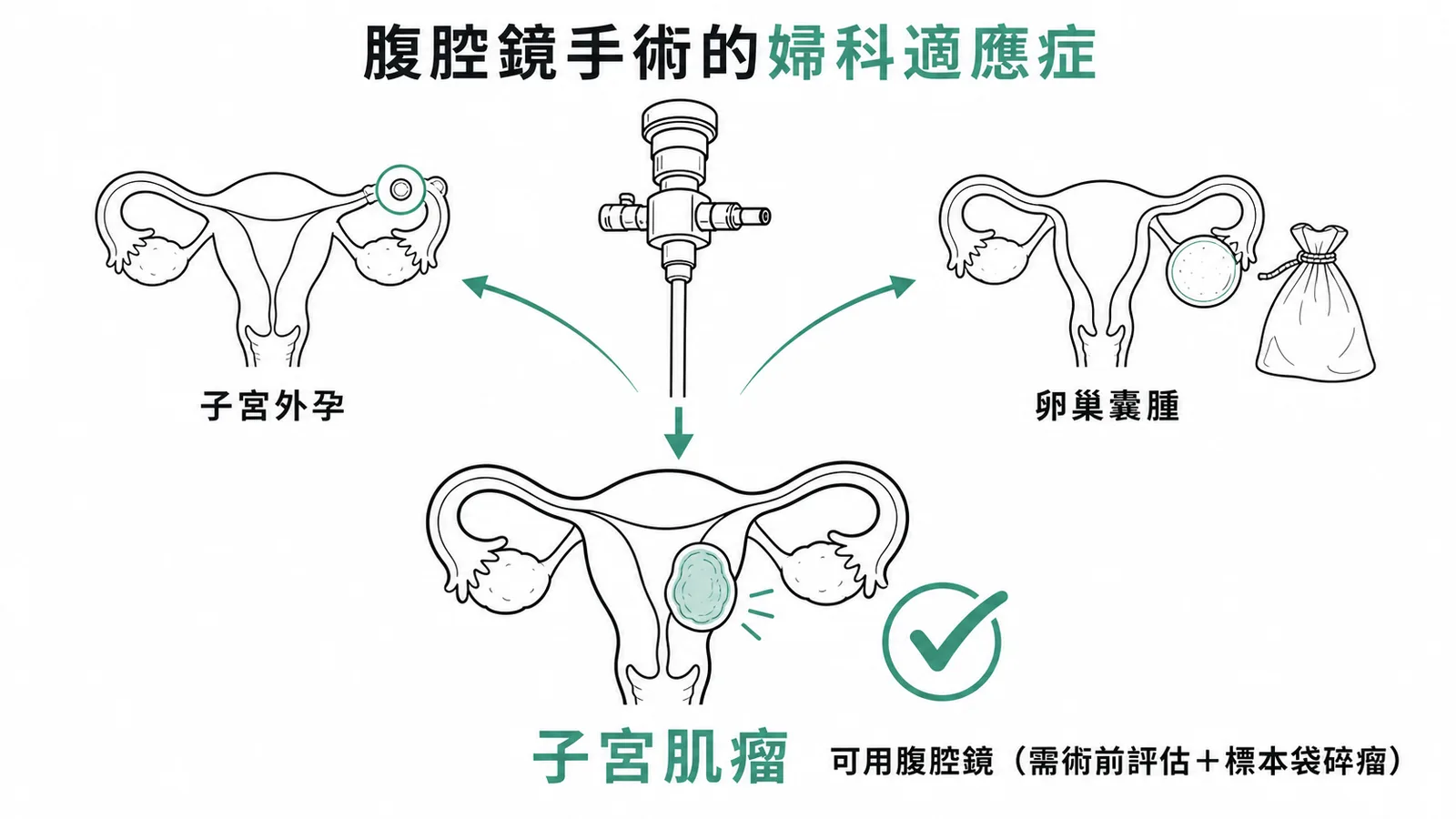 腹腔鏡婦科適應症包含子宮外孕卵巢囊腫及子宮肌瘤