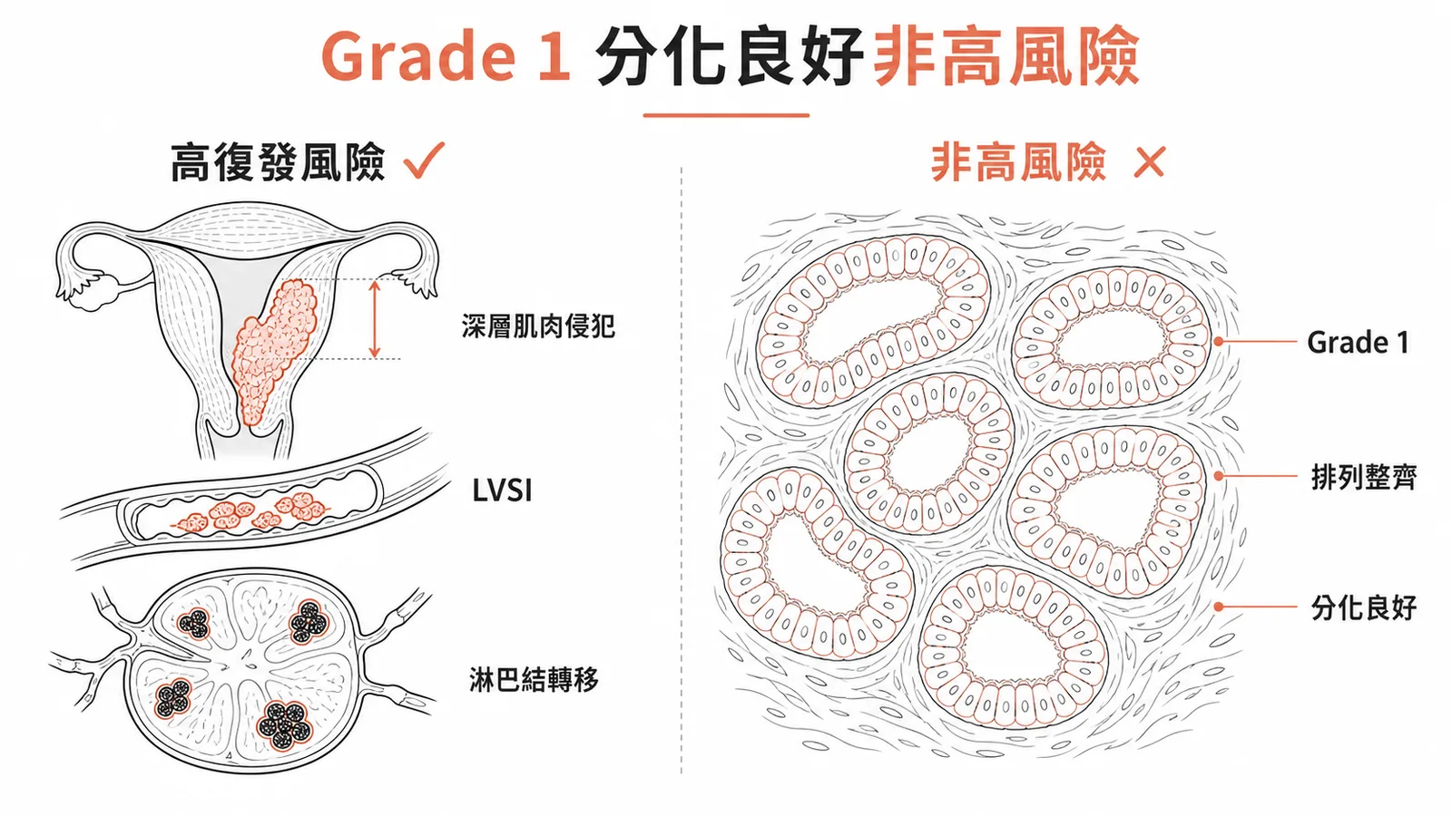 Grade 1 分化良好非子宮內膜癌復發高風險因子,高風險為深層侵犯、LVSI、淋巴結轉移