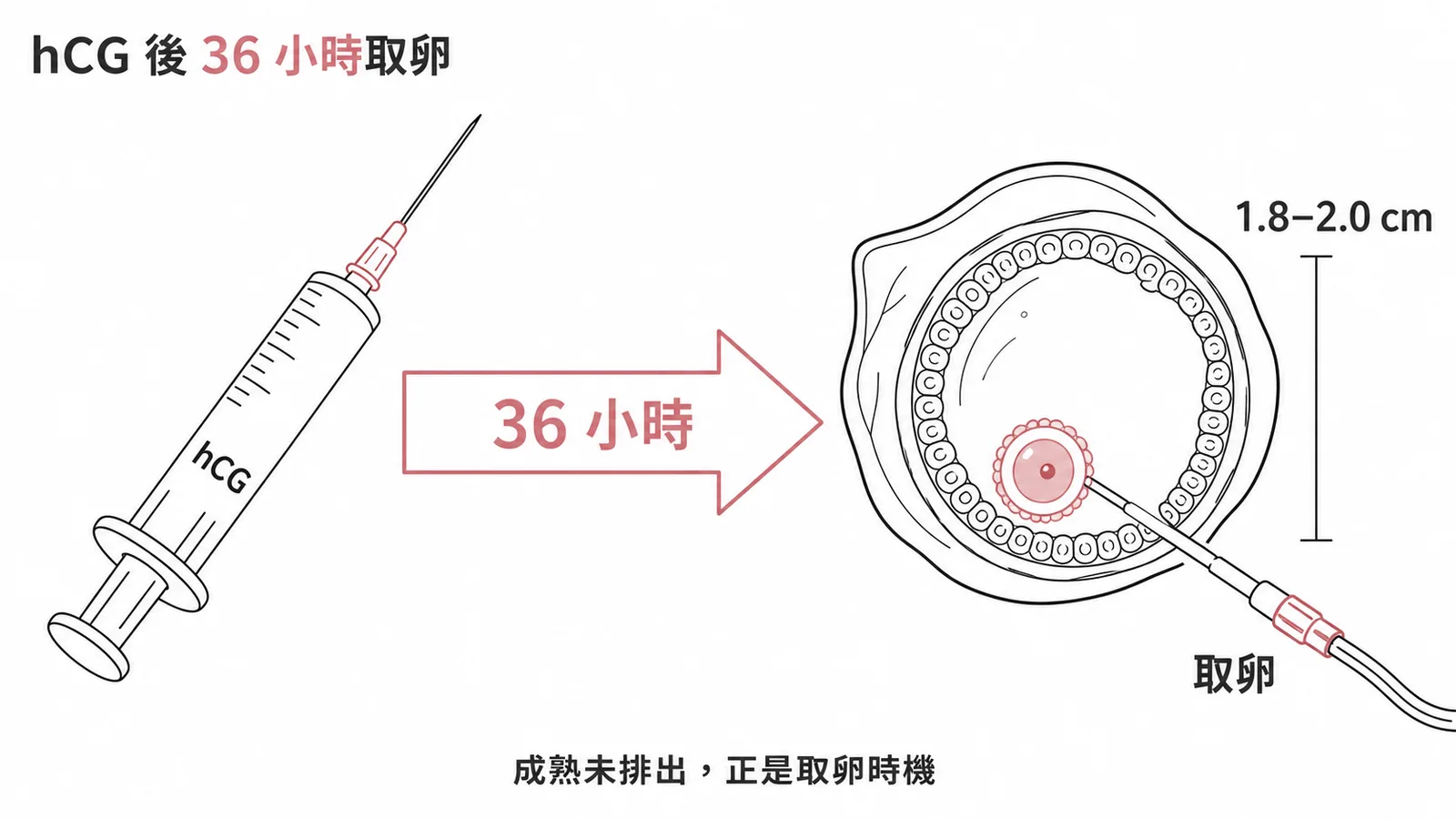 hCG注射後36小時為最佳取卵時機示意圖