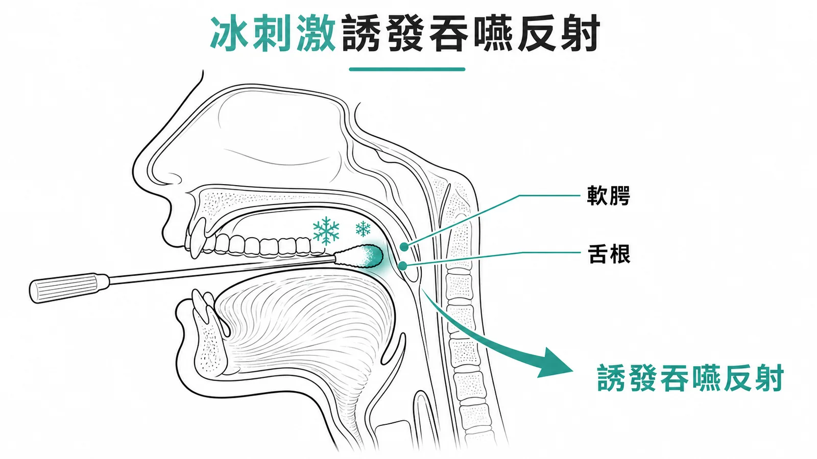冰冷棉棒刺激舌根軟腭誘發吞嚥反射示意圖