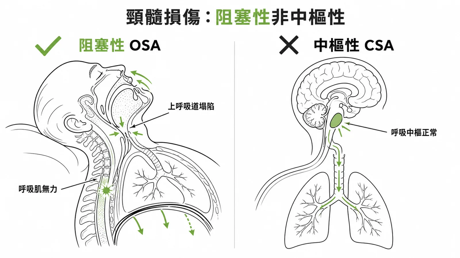 頸髓損傷睡眠呼吸障礙以阻塞性OSA為主而非中樞性CSA