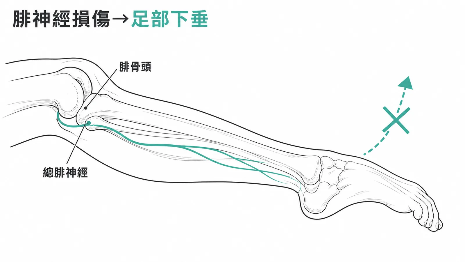 腓神經在腓骨頭處損傷導致足部下垂示意圖