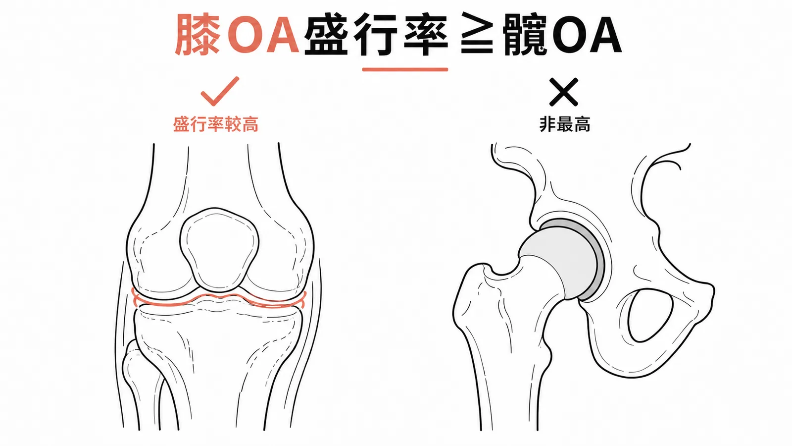 膝關節退化性關節炎盛行率高於或等於髖關節示意圖