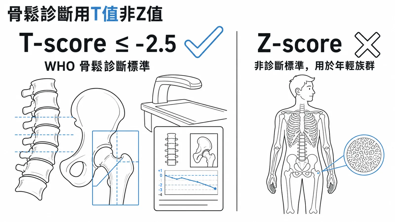 骨質疏鬆症診斷用T-score而非Z-score示意圖