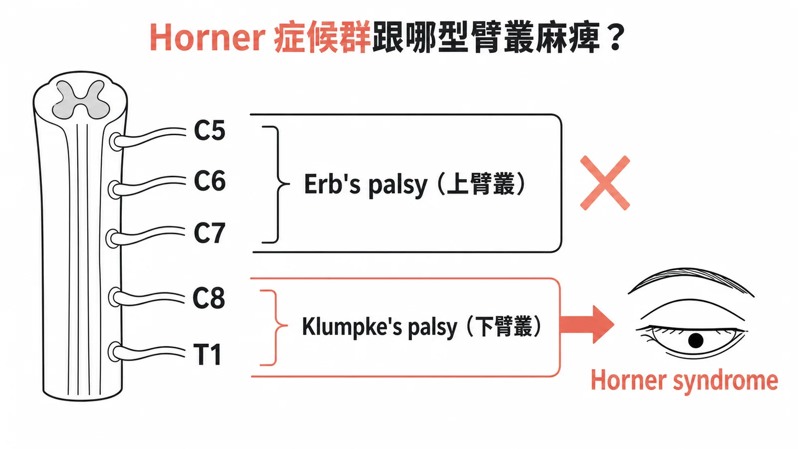 Erb's palsy(上臂叢 C5-C7)與 Klumpke's palsy(下臂叢 C8-T1)的分段示意:Horner syndrome 歸屬下臂叢