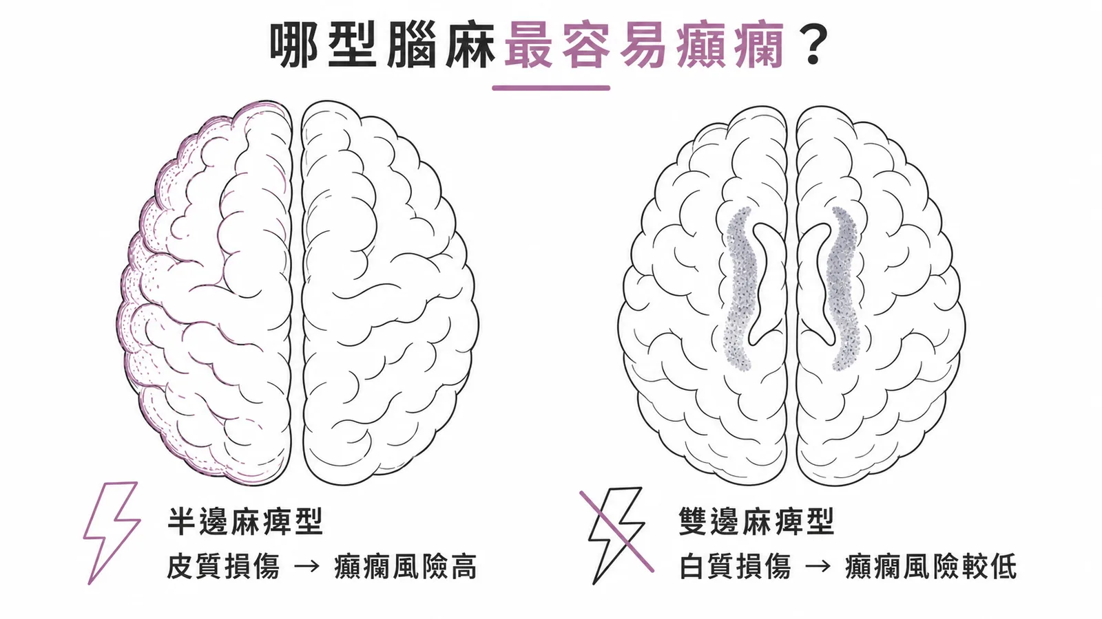 腦性麻痺類型與癲癇風險對比:半邊麻痺型皮質損傷癲癇風險高,雙邊麻痺型白質損傷風險較低
