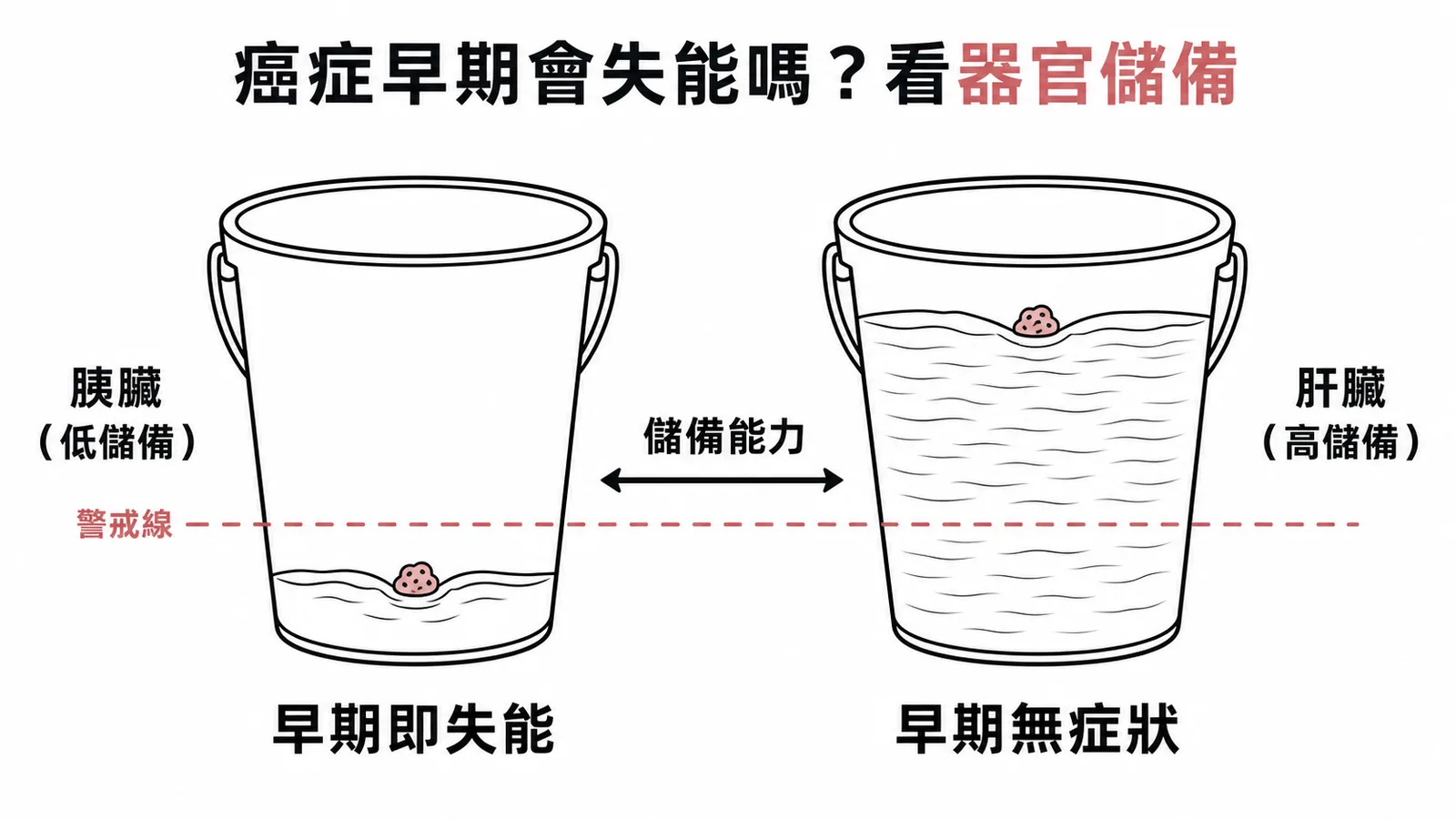 器官功能儲備與癌症早期失能的水桶比喻：低儲備早期即失能、高儲備早期無症狀