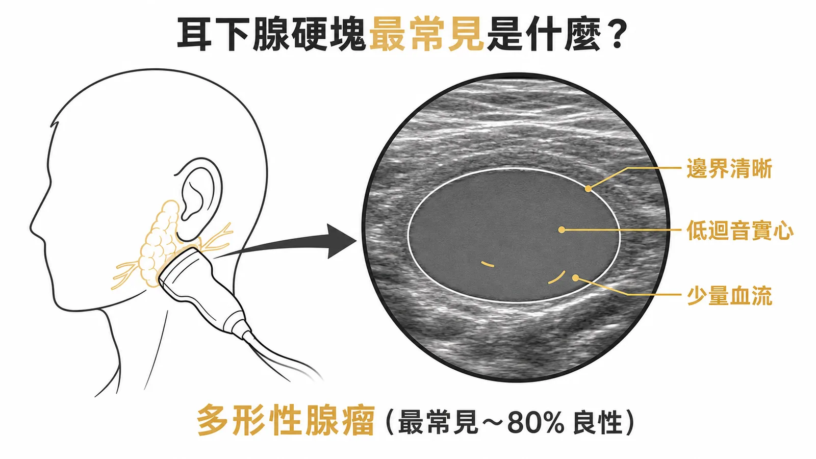 耳下腺多形性腺瘤超音波特徵：邊界清晰、低迴音實心、少量血流