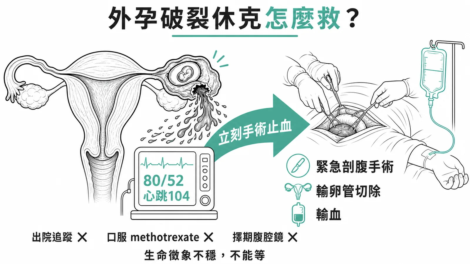子宮外孕破裂休克的緊急處置對比:緊急剖腹手術止血為正確做法,出院追蹤、口服methotrexate、擇期腹腔鏡皆不適當