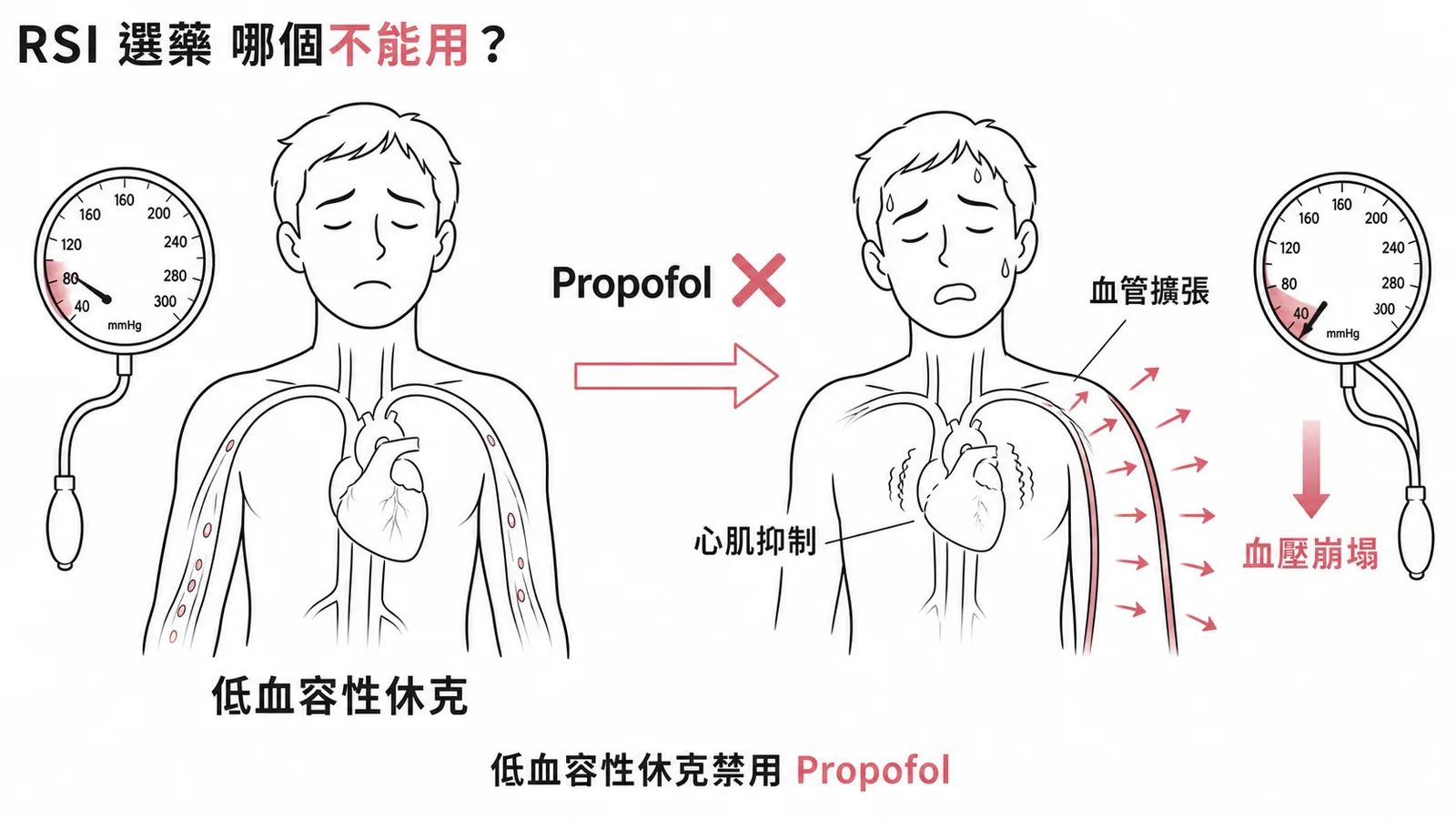 RSI插管選藥禁忌:低血容性休克禁用propofol,因血管擴張與心肌抑制導致血壓崩塌
