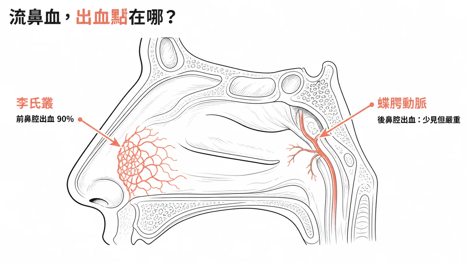 流鼻血出血點解剖：前鼻腔90%來自李氏叢，後鼻腔來自蝶腭動脈