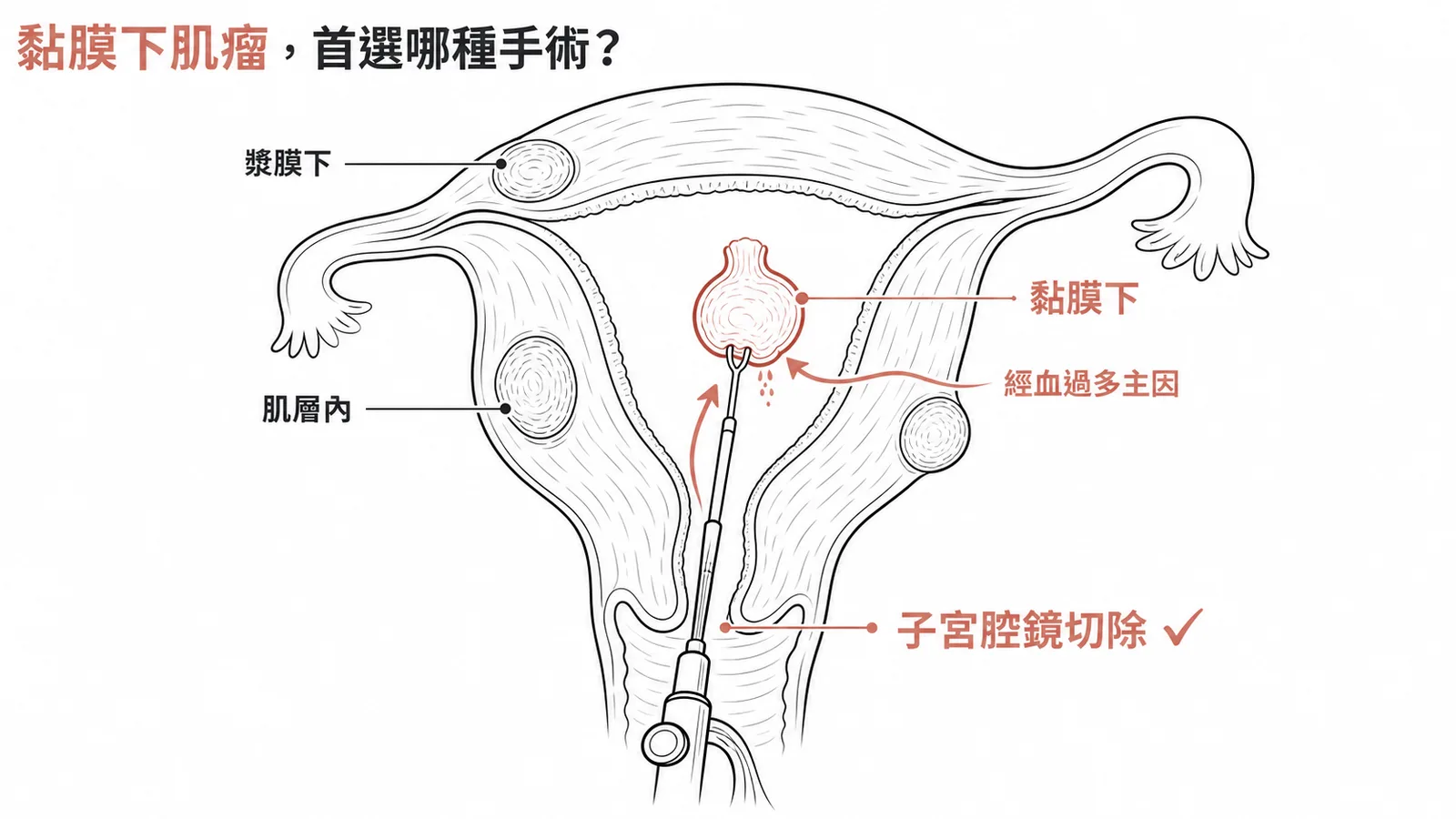 黏膜下子宮肌瘤分類與手術選擇:黏膜下肌瘤為經血過多主因,首選子宮腔鏡切除