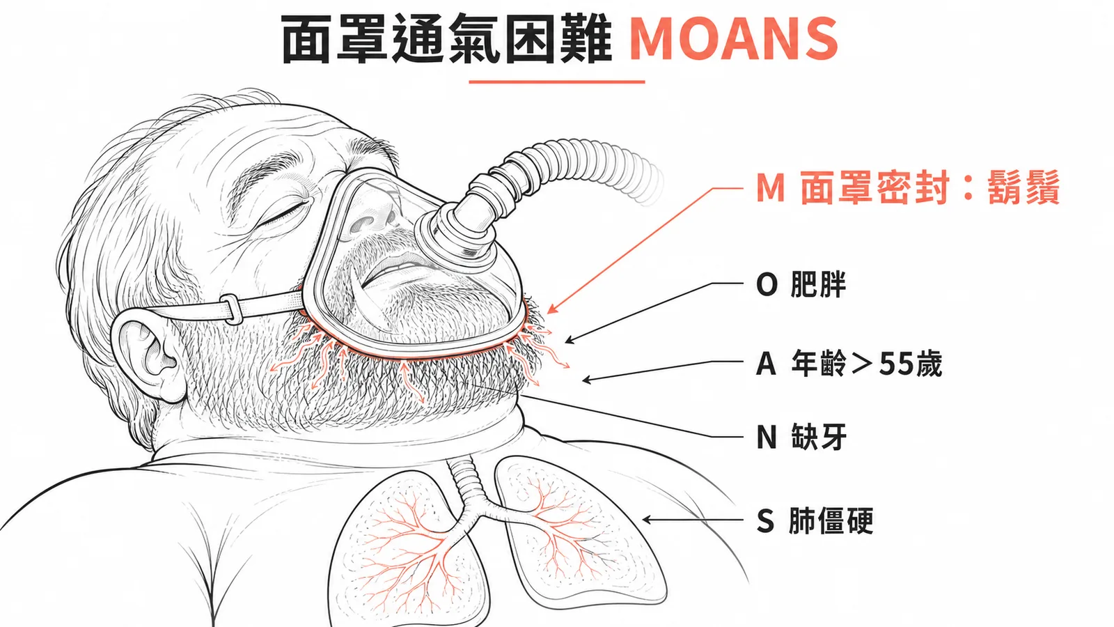 面罩通氣困難 MOANS 口訣：鬍鬚影響面罩密封為本題正解