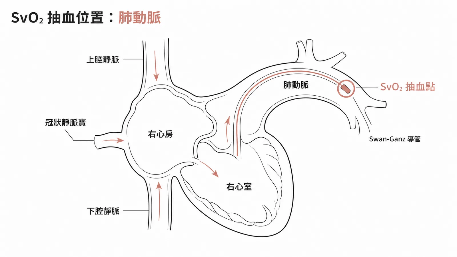 SvO2 抽血位置：上下腔靜脈與冠狀靜脈竇匯入右心後於肺動脈完全混合