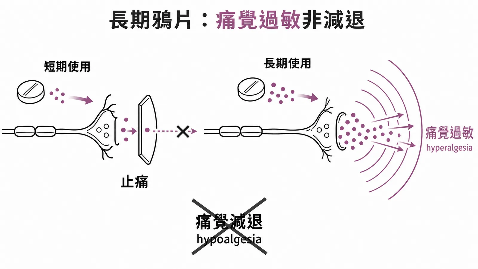 長期鴉片類藥物使用導致痛覺過敏而非痛覺減退