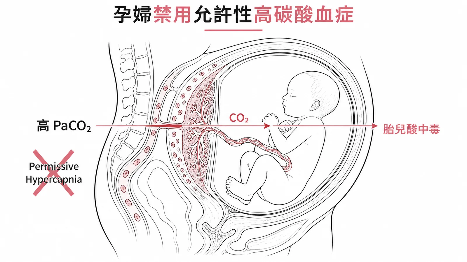 孕婦禁用允許性高碳酸血症:CO2 經胎盤致胎兒酸中毒