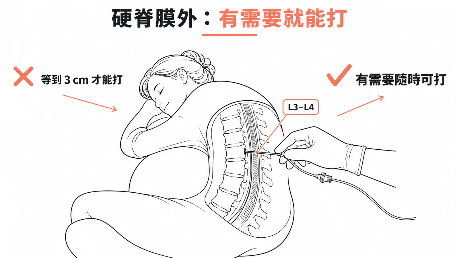 硬脊膜外止痛不需等子宮頸 3cm,有需要隨時可打