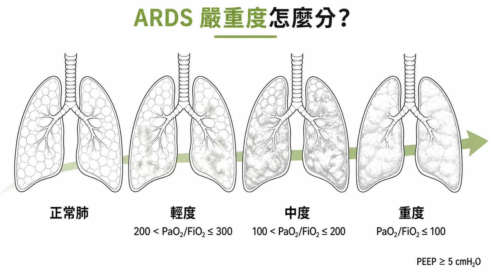 ARDS 依 PaO2/FiO2 比值分為輕度、中度、重度三級的漸進示意圖