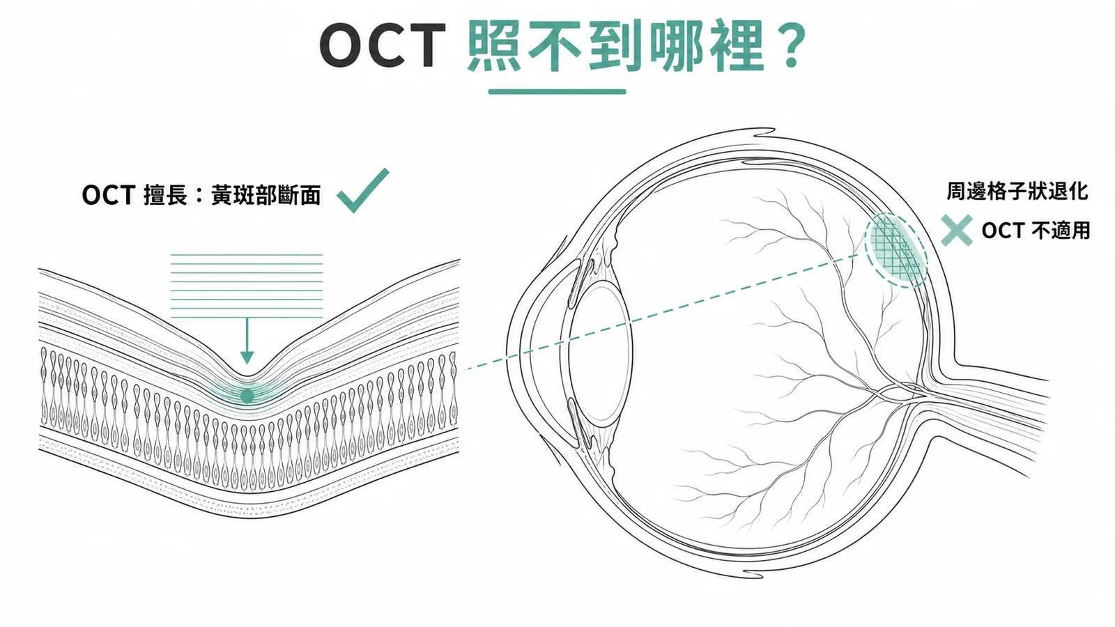 OCT 擅長黃斑部斷面但無法檢查周邊格子狀退化的對照示意圖