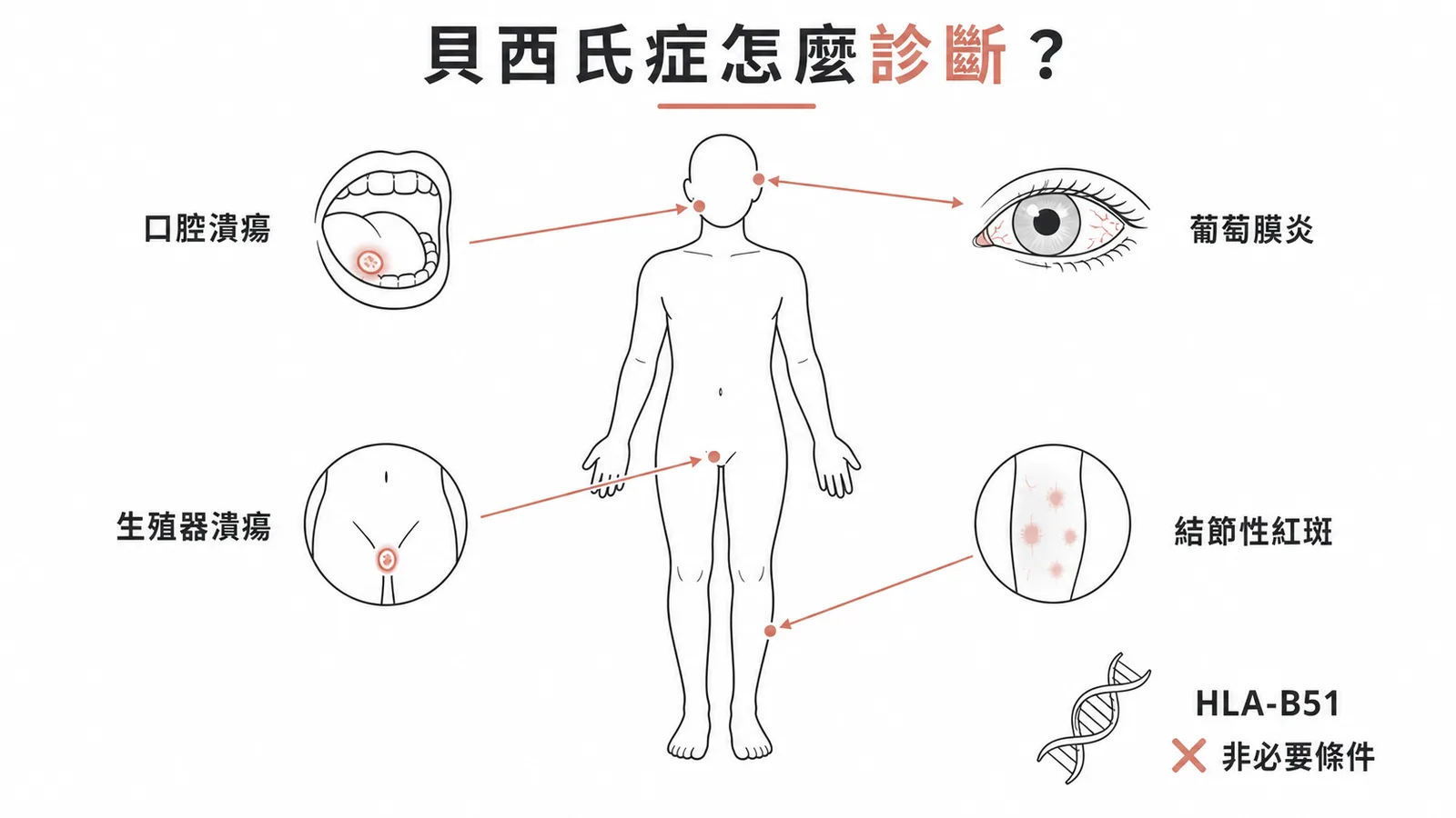 貝西氏症依臨床症狀組合診斷而非 HLA-B51 的示意圖