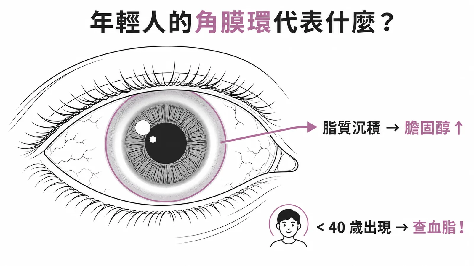 年輕人角膜環代表脂質沉積與高膽固醇的示意圖