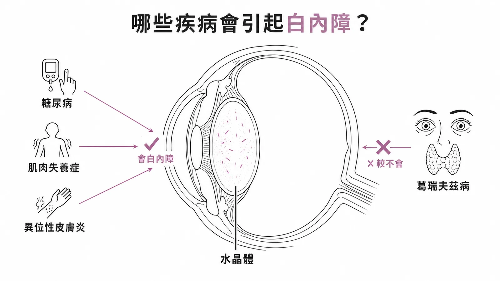 糖尿病、肌肉失養症、異位性皮膚炎會合併白內障，葛瑞夫茲病較不會