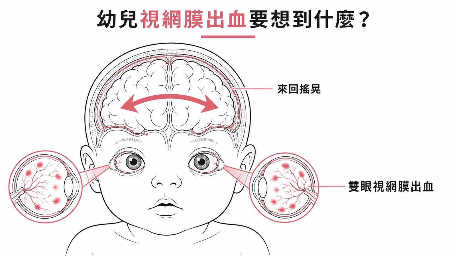 幼兒雙眼視網膜出血無明顯外傷應懷疑嬰兒搖晃症的示意圖