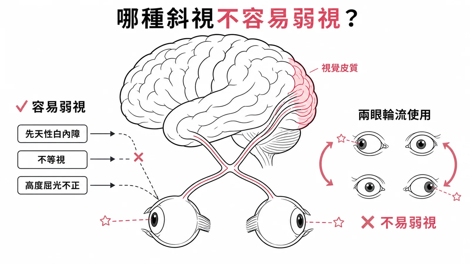 間歇性交替性外斜視兩眼輪流使用故不易弱視的示意圖