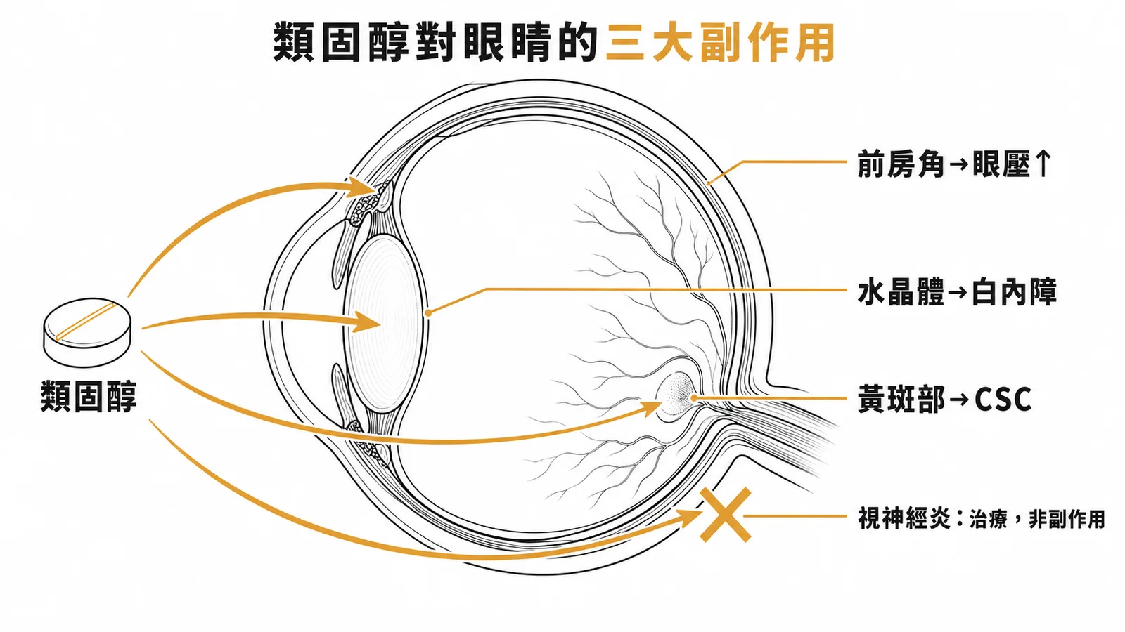 類固醇三大眼部副作用：白內障、眼壓升高、CSC，視神經炎則是治療而非副作用