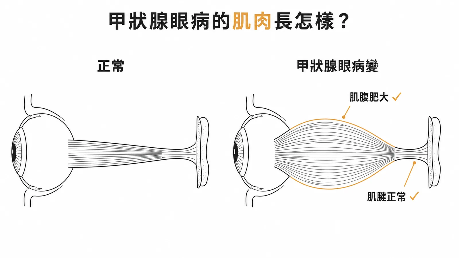 甲狀腺眼病變肌腹肥大但肌腱正常的對照示意圖