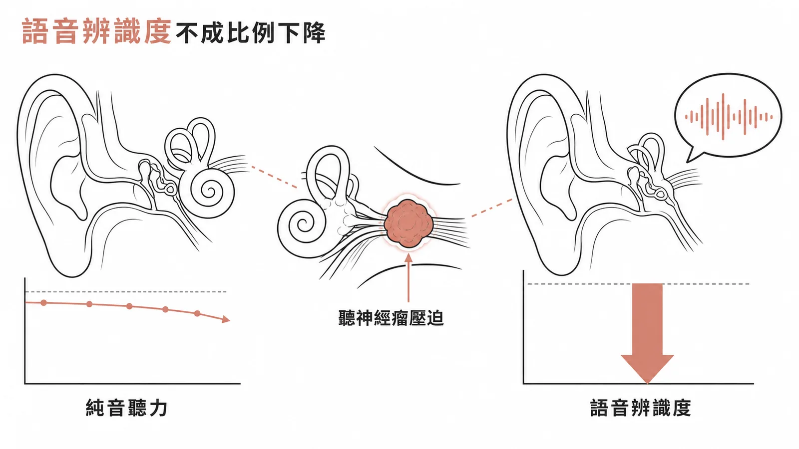 聽神經瘤導致語音辨識度不成比例下降的對比示意圖