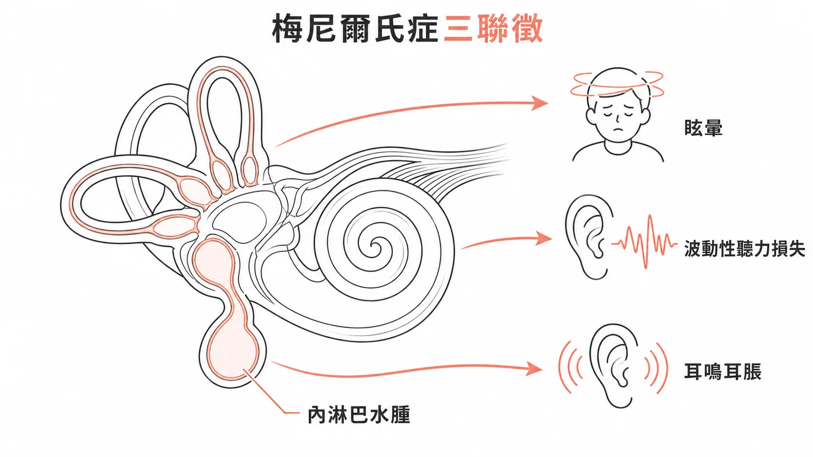 梅尼爾氏症三聯徵:內淋巴水腫導致眩暈、波動性聽力損失與耳鳴耳脹