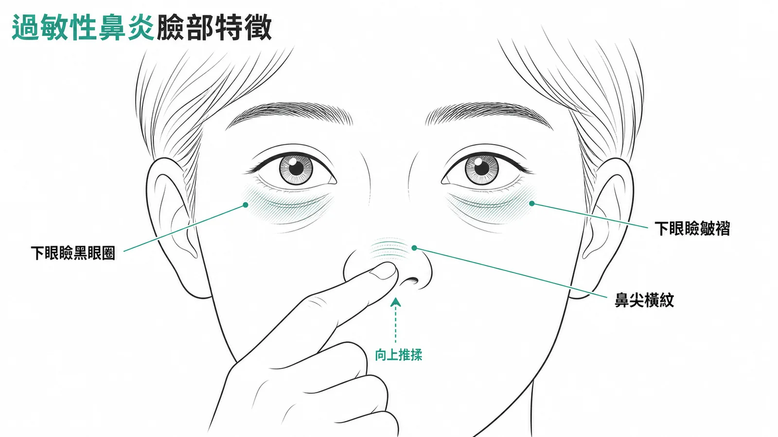 過敏性鼻炎臉部特徵:鼻尖橫紋、下眼瞼黑眼圈與皺褶