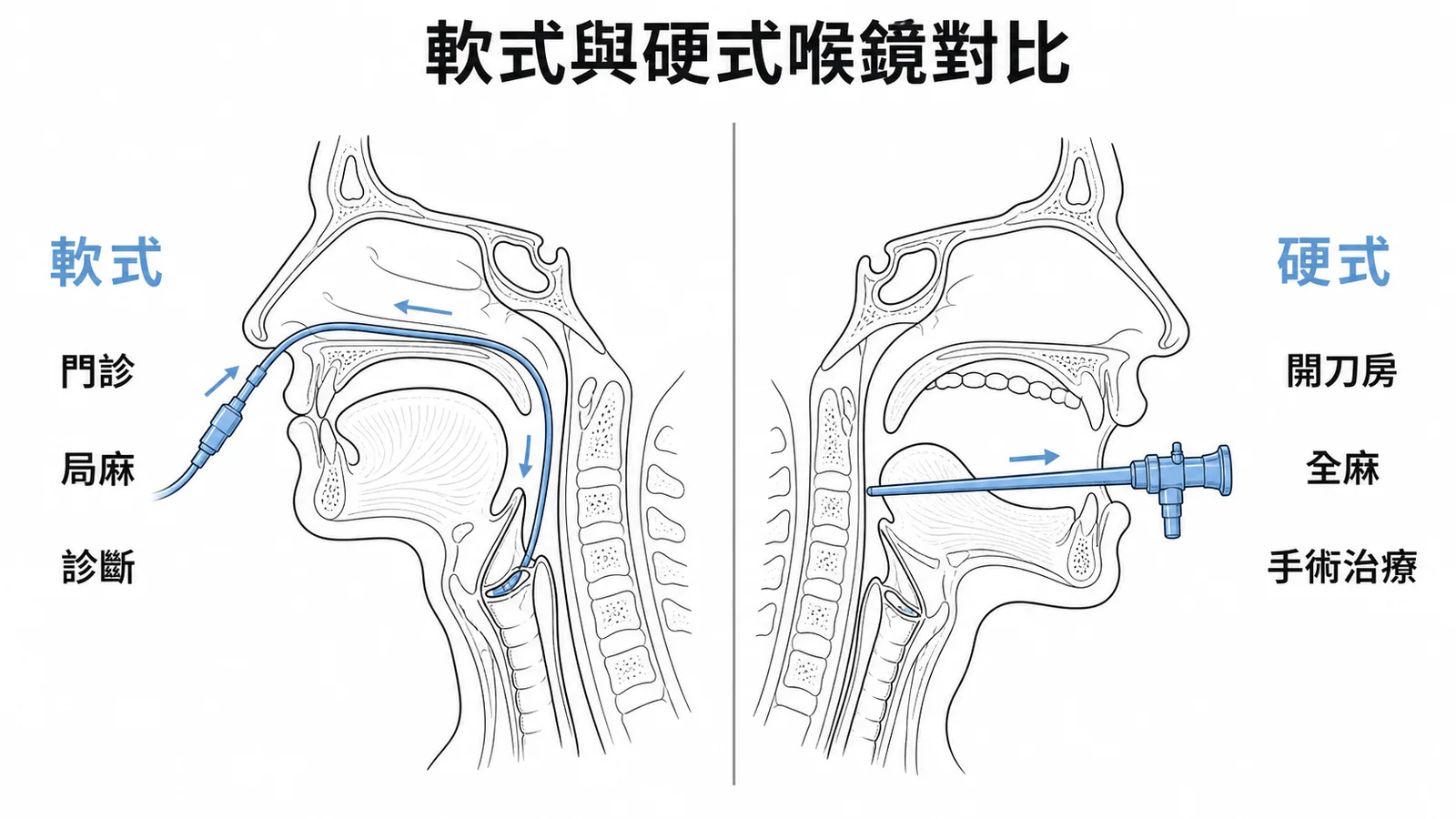 軟式與硬式喉鏡對比：軟式經鼻門診局麻診斷，硬式經口開刀房全麻手術