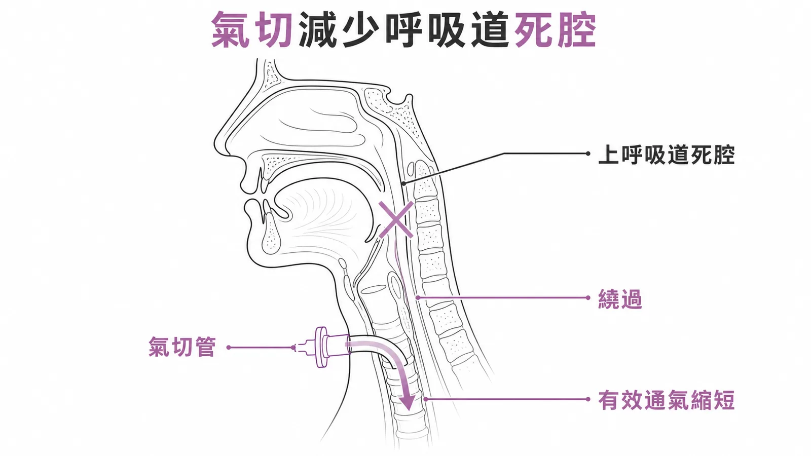 氣切管繞過上呼吸道死腔，縮短有效通氣路徑