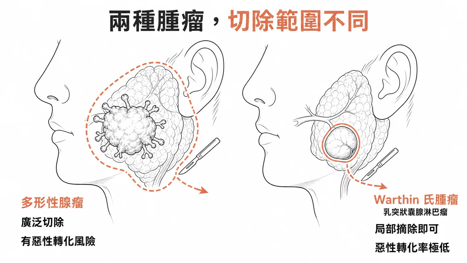 多形性腺瘤需廣泛切除,Warthin氏腫瘤局部摘除即可的對比