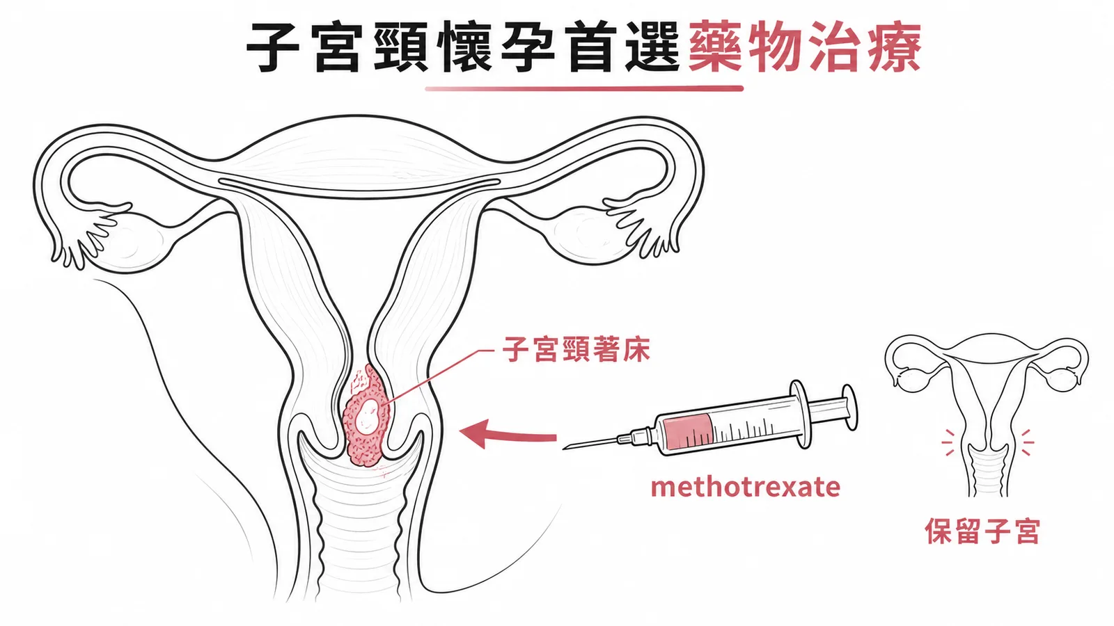 子宮頸懷孕首選methotrexate藥物治療示意圖