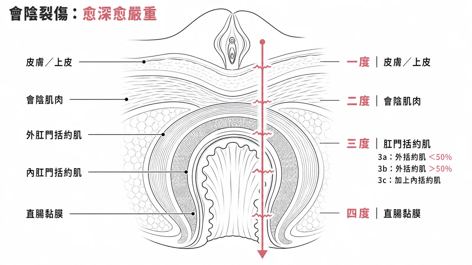 會陰裂傷四度分級剖面示意圖